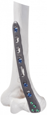 Humerus-distal-dorsolateral_AF-Medical_146-1_cut