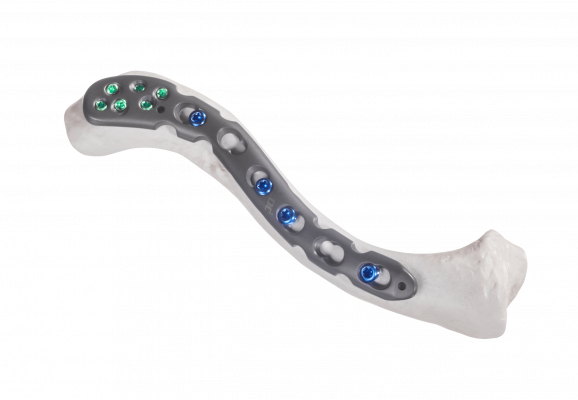 Clavicle-lateral-extension_AF-Medical_165