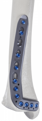 Tibia-distal-anterolateral-1