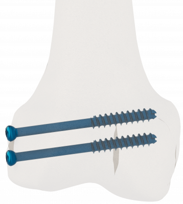 Cannulated_Screws_A_EF